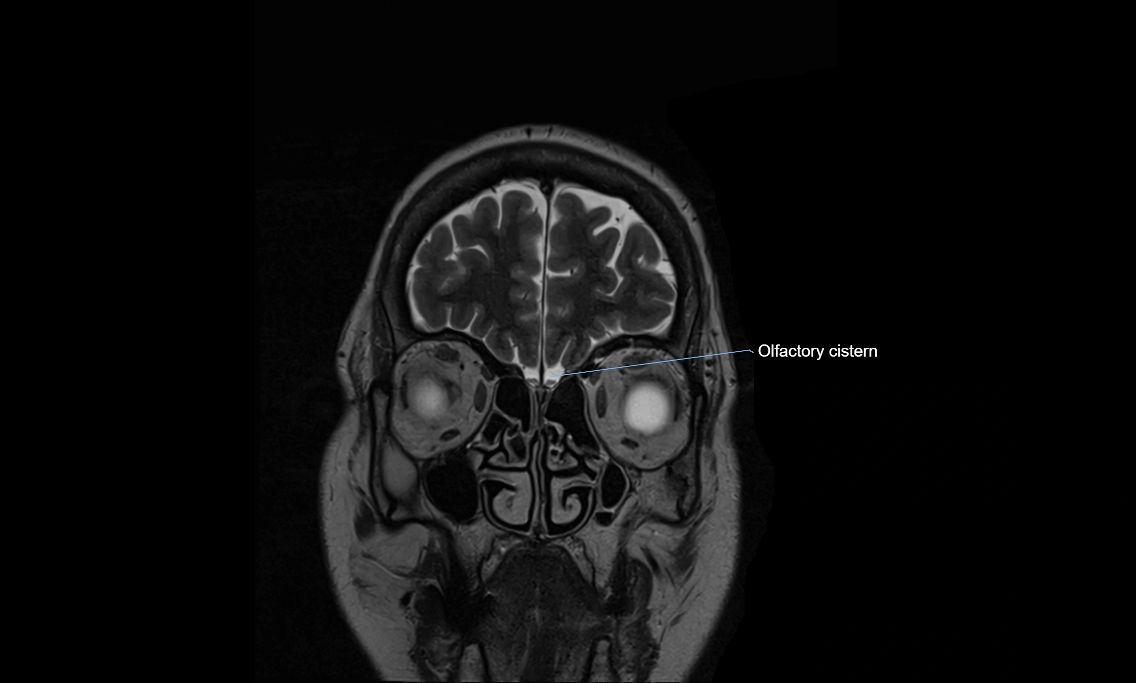Brain cisterns  and ventricles coronal anatomy 3T MRI image-img-00001-00004.webp